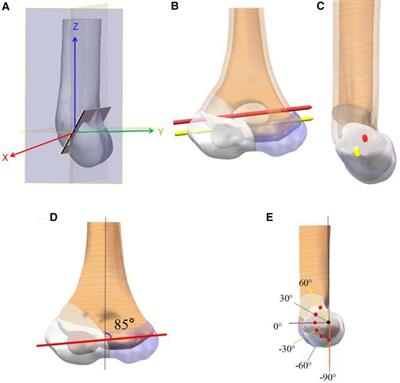 Finite element analysis of Kirschner wire fixation for lateral condyle fracture in children in the sagittal plane